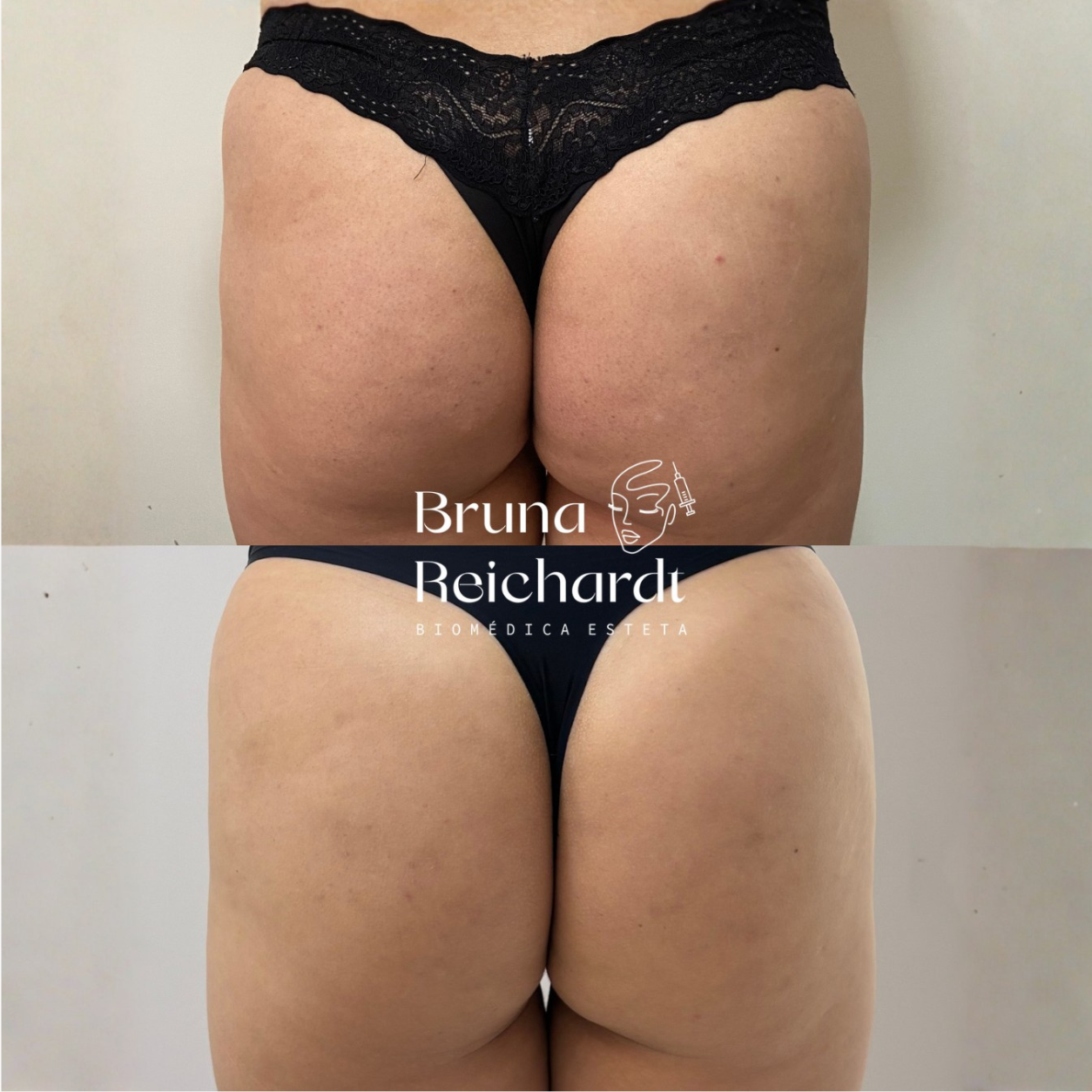 Antes e depois de harmonização de glúteo com o protocolo BumbumUp