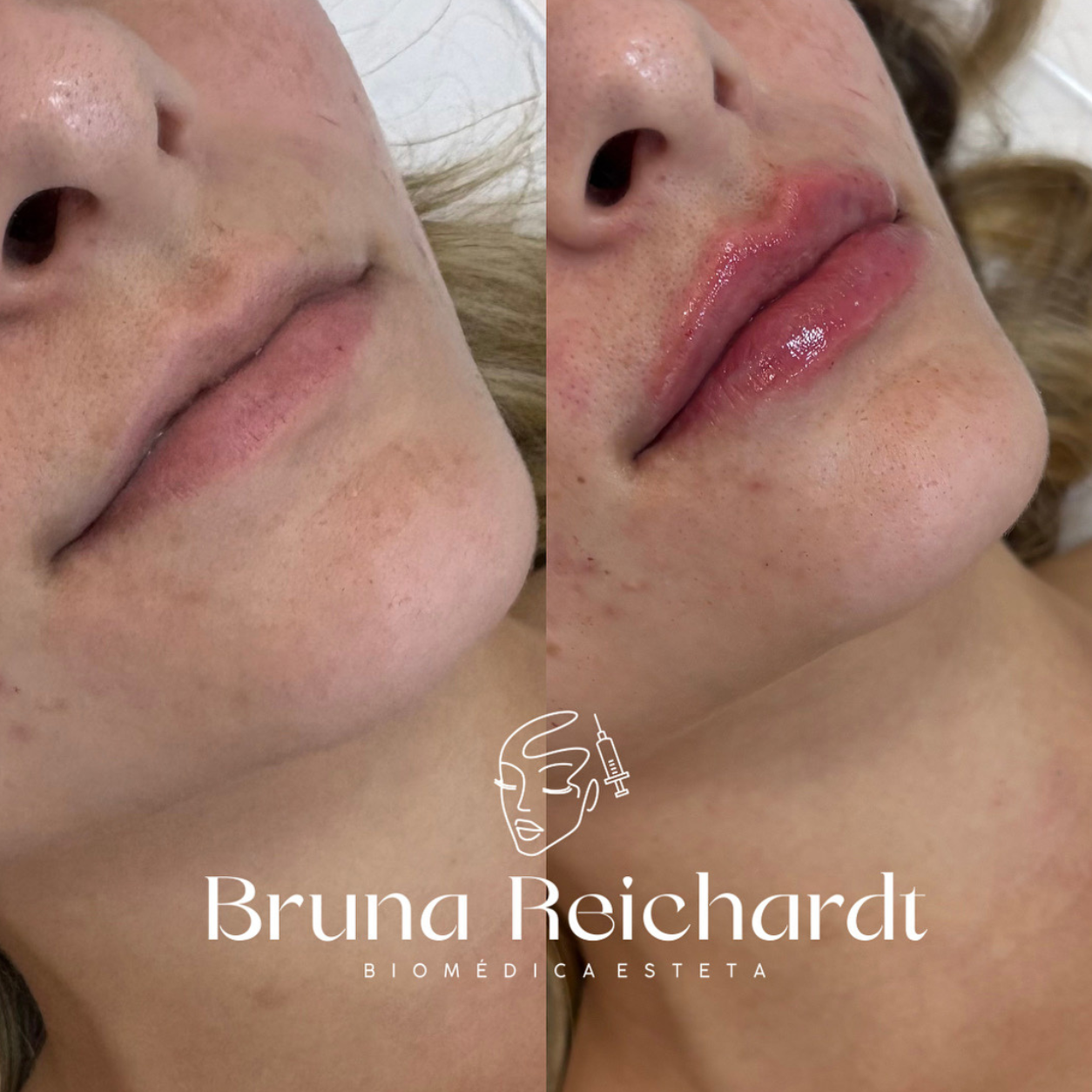 Antes e depois de preenchimento labial com ácido hialurônico